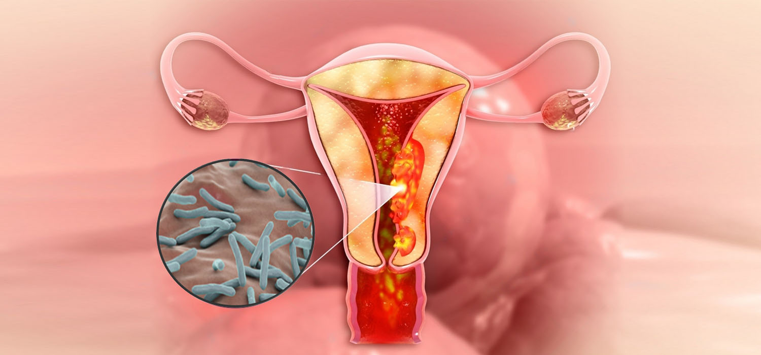 Genital Tuberculosis: A Hidden Cause of Female Infertility in India